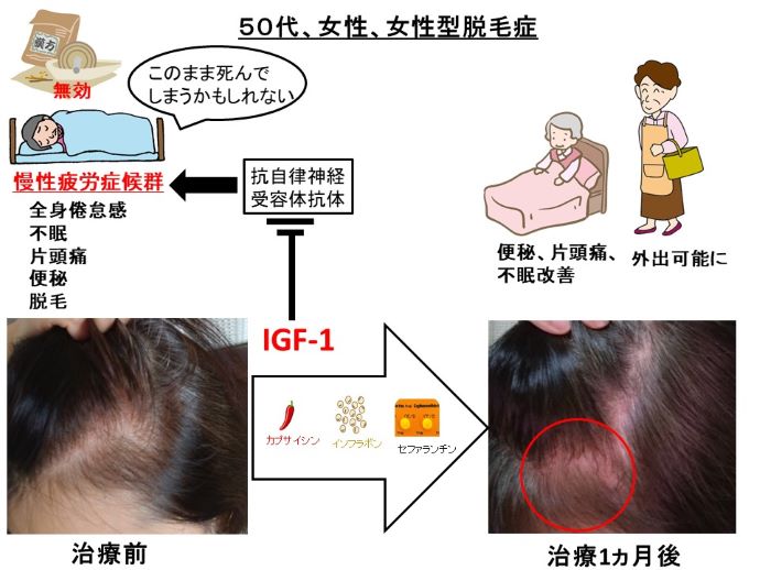 円形脱毛症　病院